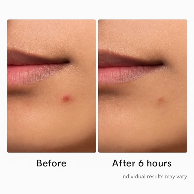 Hydrocolloid Acne Pimple Patch – 72 Count (9mm & 12mm) | Invisible Spot Patches for Pimples, Zits, Blemishes & Whiteheads | Fast Healing, Waterproof, Strong Adhesion & Gentle on Skin